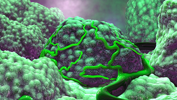 3d-tumor-1