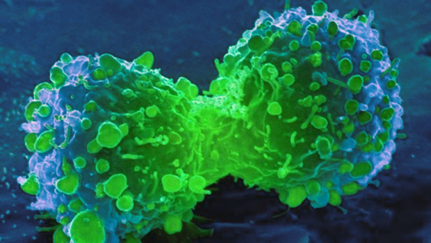 3d-tumor-2